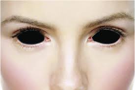 what a black eye looks like